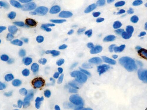IHC of Tryptase on an FFPE H. pylori Infected Stomach Tissue